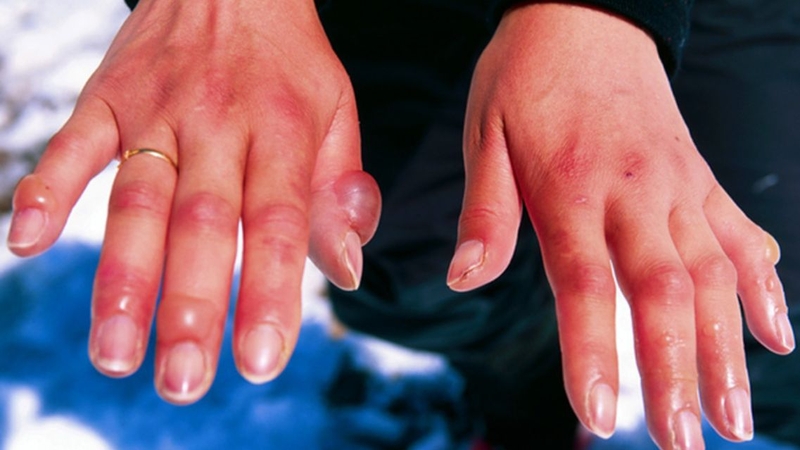 Nguy cơ bỏng lạnh nếu dùng đá khô không đúng cách