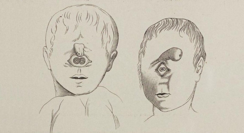 Hội chứng Cyclopia là một dị tật bẩm sinh cực kỳ hiếm gặp