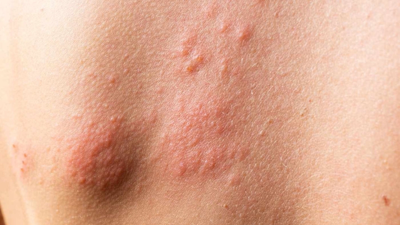 Hình ảnh phát ban trên da HIV là tình trạng da xuất hiện các nốt đỏ, hồng hoặc tím, có thể gây ngứa, rát hoặc đau nhẹ