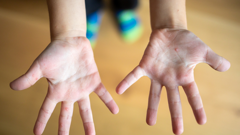 Ca nặng tăng gây áp lực lớn lên bệnh viện và phụ huynh