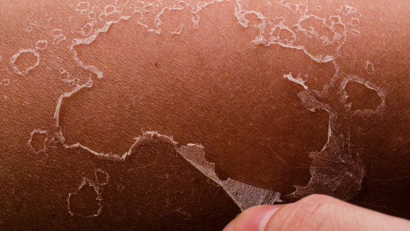 Triệu chứng của thận yếu biểu hiện ở da